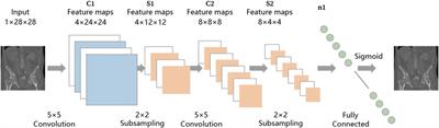 Artificial intelligence assisted preoperative planning and 3D-printing guiding frame for percutaneous screw reconstruction in periacetabular metastatic cancer patients